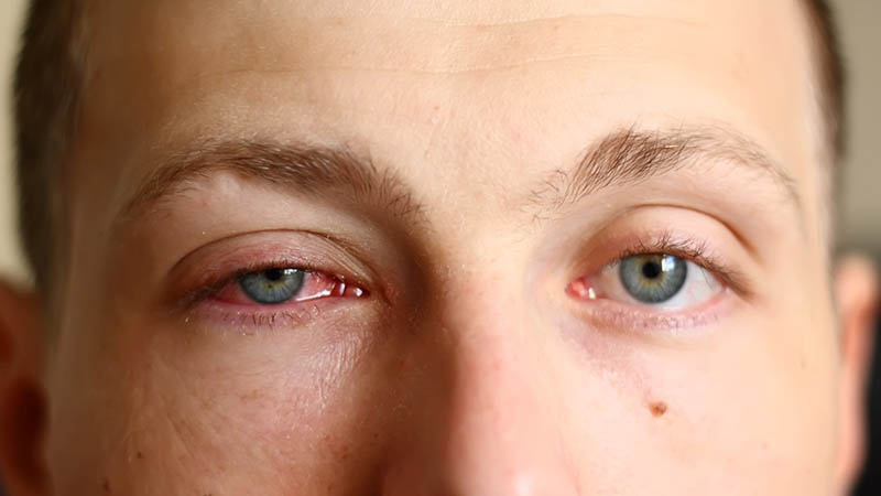 Silmän sidekalvon tulehdus